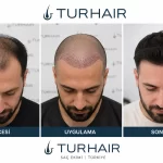 Cheap Hair Transplant Turkey before and after results at TURHAIR clinic in Istanbul showing successful hair restoration transformation.