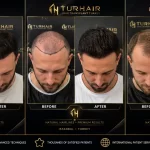 Turkey hair transplant reviews before and after results at TurHair Istanbul showcasing natural hairline restoration and high-density hair transplant outcomes.