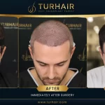 3000–4000 graft hair transplant Turkey before and after results at TurHair showing hairline restoration and natural density after 9 months