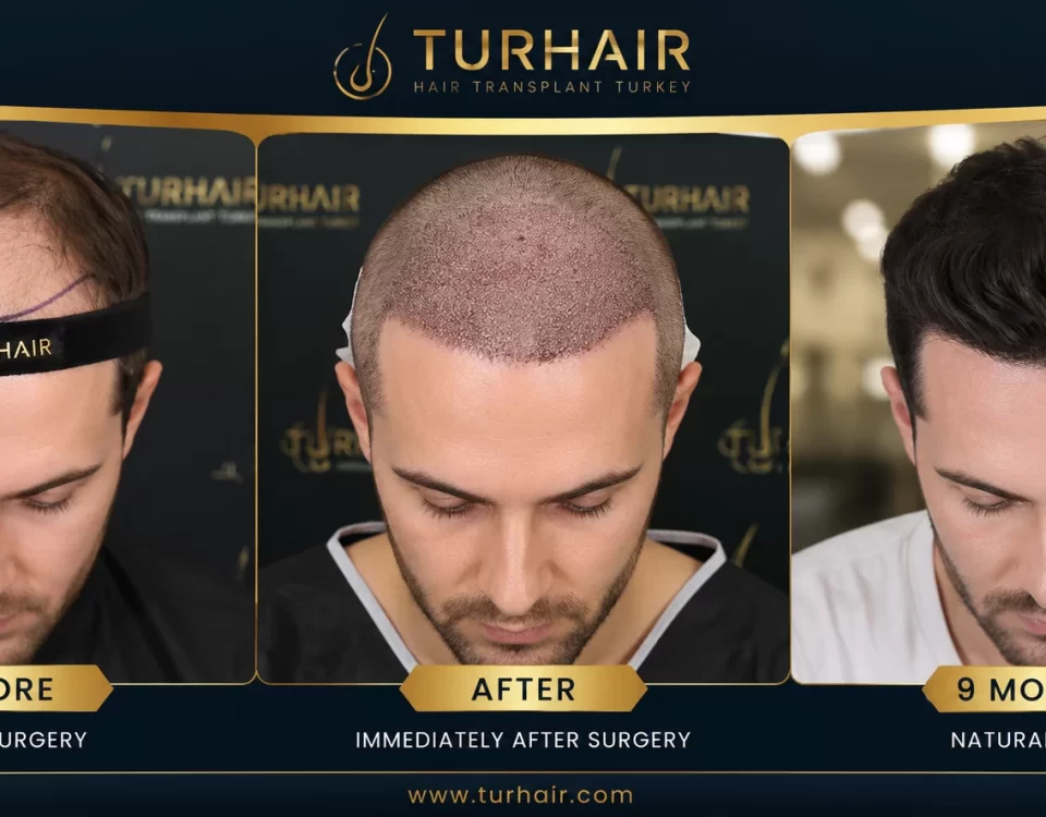 3000–4000 graft hair transplant Turkey before and after results at TurHair showing hairline restoration and natural density after 9 months