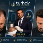 Dr. Demir performing a doctor-led hair transplant procedure at Turhair Clinic in Turkey with before and after hair transplant results.