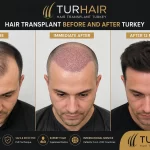 Hair Transplant Before and After Turkey by TurHair showing before surgery, immediate post-operation results, and 12-month hair growth transformation.