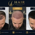 Hair Transplant Repair Turkey before and after results showing failed hair transplant correction and natural hairline restoration at TurHair Istanbul.