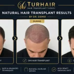 Hair transplant success rate in Turkey before and after results by Dr Demir at TurHair Clinic Istanbul