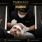 Sapphire FUE Turkey before and after hair transplant results by TurHair in Istanbul.