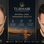 Hair Transplant in France vs Turkey 2026 comparison by TurHair Istanbul showing before and after hair transplant results