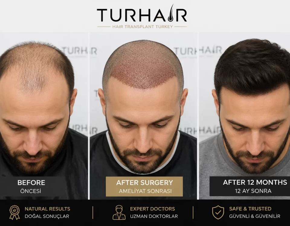 Hair Transplant Turkey Before and After by TurHair showing natural hairline restoration and 12-month results
