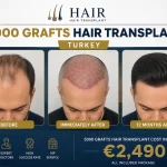 5000 Grafts Hair Transplant Cost Turkey – TurHair Clinic