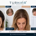 Female Hair Transplant in Turkey Results 2026 – TurHair Istanbul