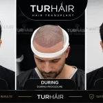 Hair Transplant Denmark vs Turkey 2026 – TurHair before, procedure and after hair transplant result