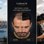 Hair Transplant in Switzerland vs Turkey 2026 – TurHair Istanbul FUE hair transplant