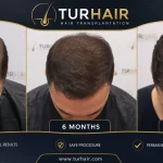Hair transplant Turkey before after results at TurHair Istanbul showing before, 6 months and 12 months hair growth