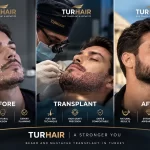 Beard and mustache transplant in Turkey at TURHAIR – before, transplant procedure and natural after result