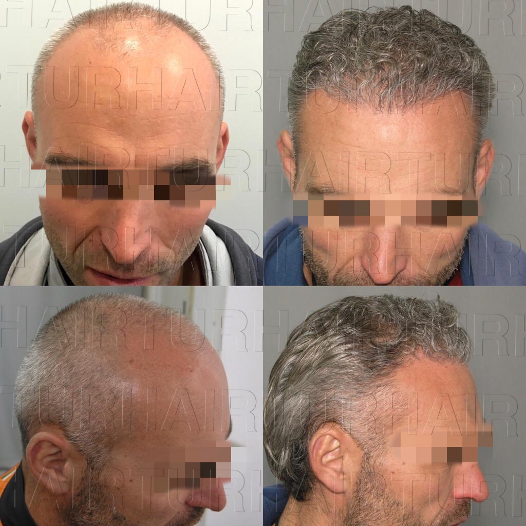 Before and after hair transplant result