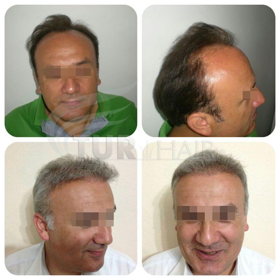 Before and after hair transplant result