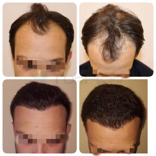 Before and after hair transplant result