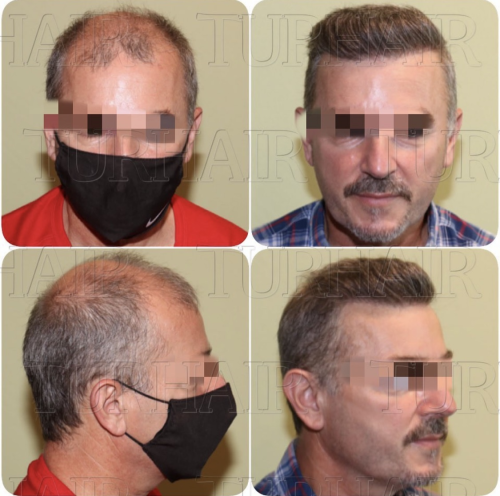 Before and after hair transplant result