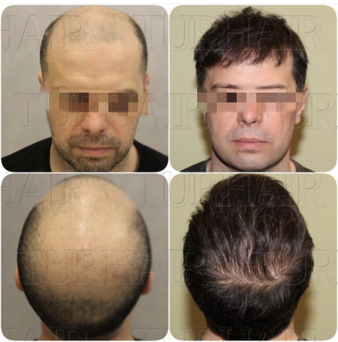 Before and after hair transplant result