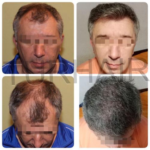 Before and after hair transplant result